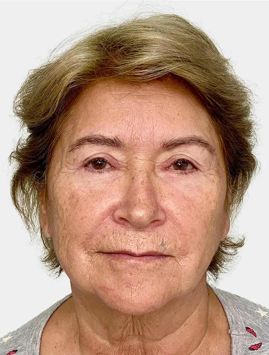 Resultado Lip Lift 3